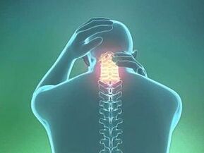 Un síntoma de la osteocondrosis cervical es un dolor de cabeza. 