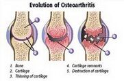 Fase de osteoartritis