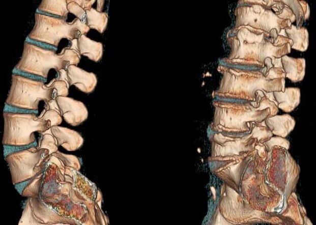 columna vertebral