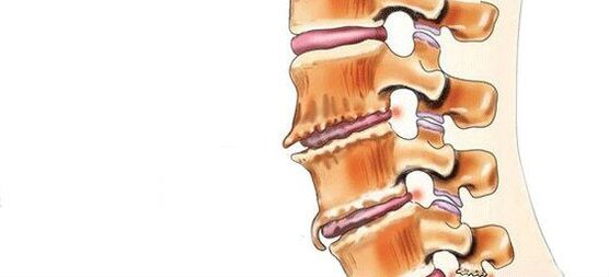 Espondilosis destrucción de articulaciones intervertebrales