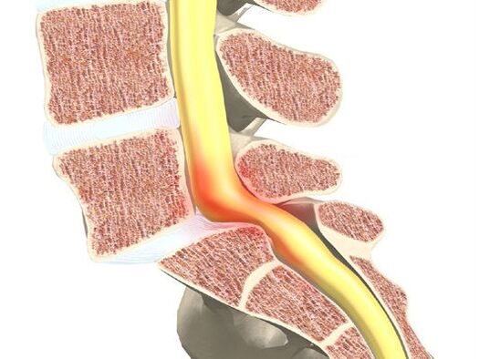 Segmento de sangre motora para osteocondosis