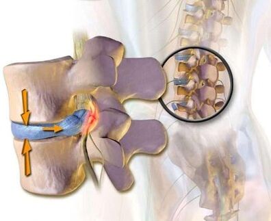Síndrome de marrón vascular