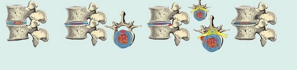 varias etapas de la osteocondrosis torácica