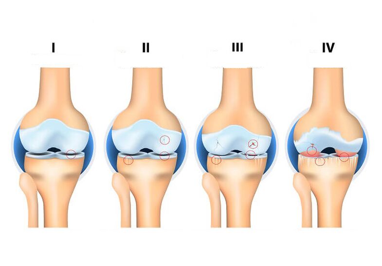 etapas de la artrosis articular