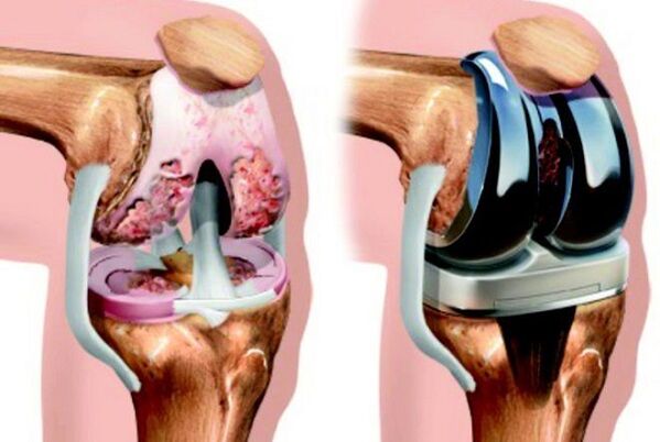 antes y después de la osteoartritis de la articulación de la rodilla para la osteoartritis